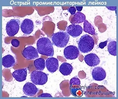 Острый промиелоцитарный лейкоз по утвержденным клиническим рекомендациям