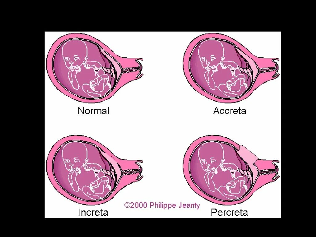 Истинное приращение. Степени врастания плаценты. Плацента Accreta increta percreta. Врастание плаценты в матку.