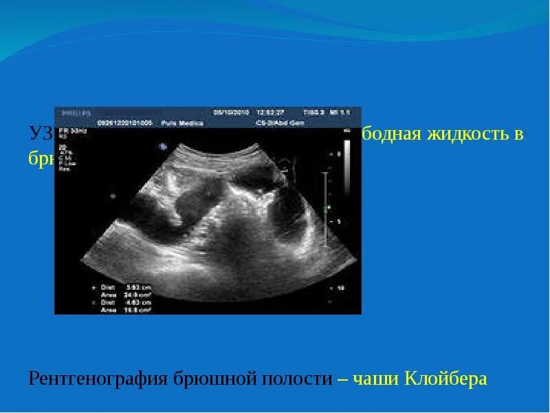 Расширение петель кишечника УЗИ. Жидкость в брюшной полости на УЗИ. Свободная жидкость на УЗИ. Свободная жидкость в брюшной полости на УЗИ. Расширение петель кишечника