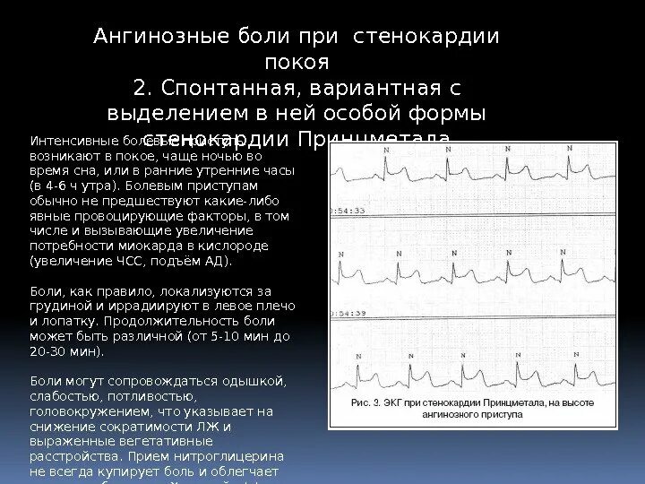 Стенокардия клинические рекомендации. Ангинозный приступ стенокардии. Купирование стенокардии напряжения. Ангинозная форма инфаркта миокарда. Ангинозная стенокардия симптомы.