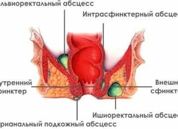 Острый парапроктит клинические рекомендации 2021