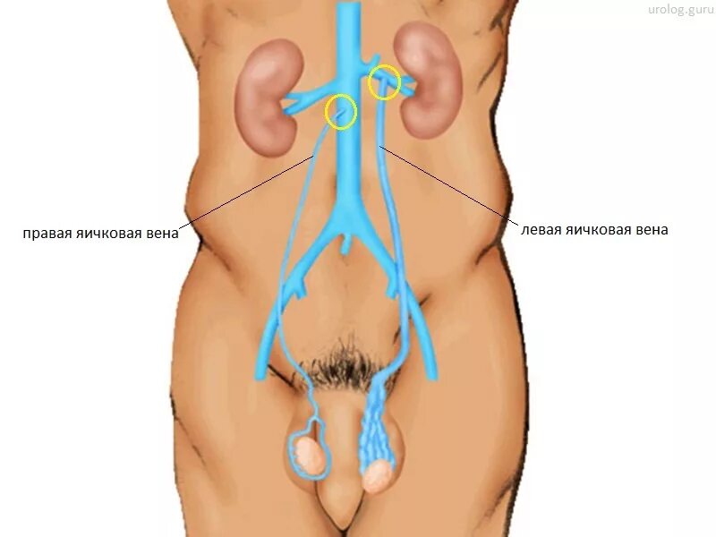 Шрам варикоцеле Мармара. Варикоцеле расширение вен. Варикоцеле семенного канатика. Варикоз вен семенного канатика. Вена левого яичка