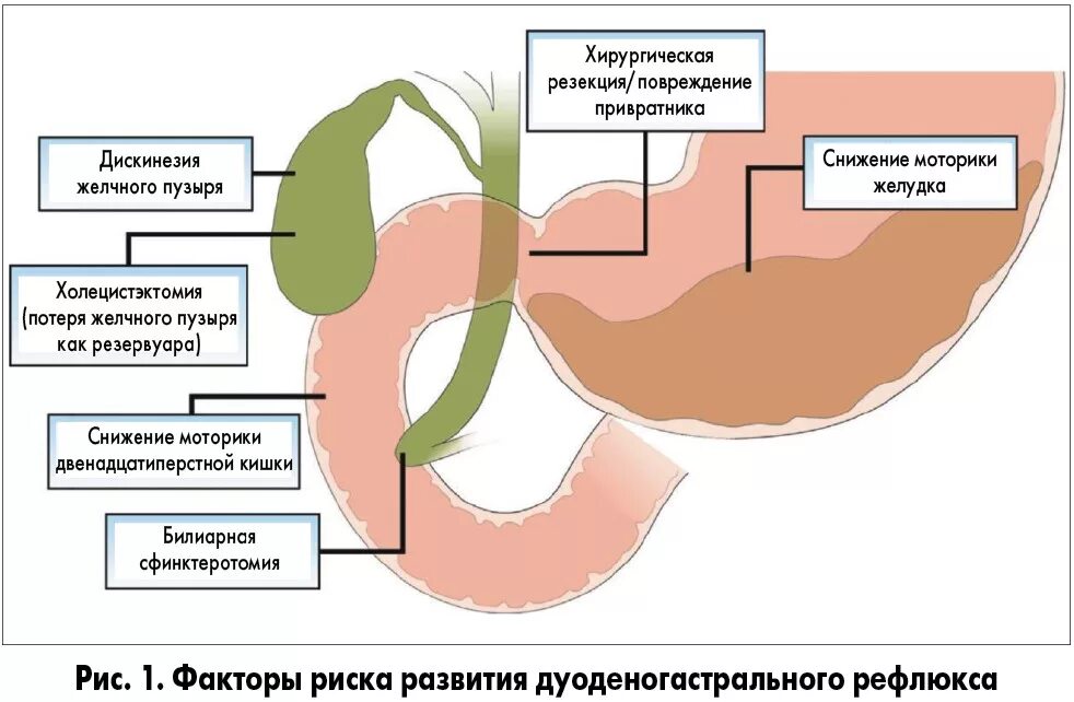 Рефлюкс 12 перстной кишки. Дуоденит гастральный рефлюкс. ДГР дуоденально-гастральный рефлюкс что это. Дуоденальный гастрит рефлюкс. Эпителиальное образование желудка что это