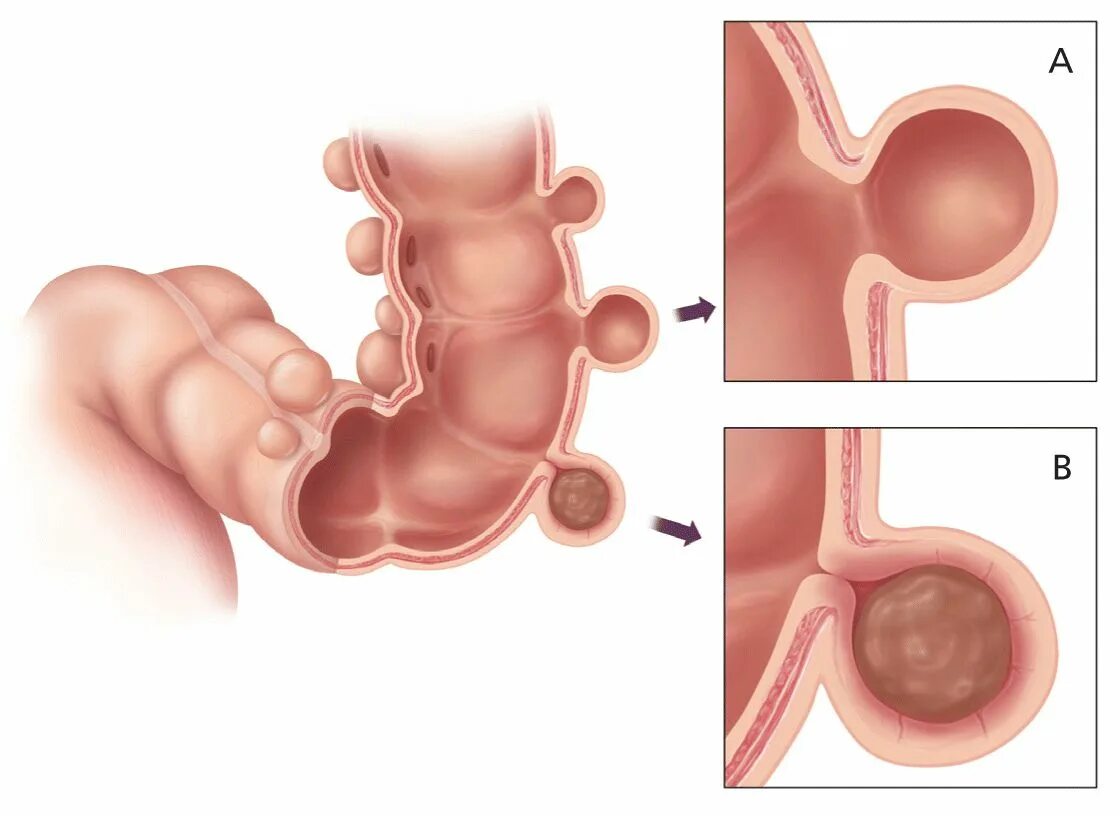 Дивертикулы сигмовидной кишки. Дивертикукулы сигмовидной кишки. Дивертикул кишечника сигмовидной кишки. Перфорация дивертикула сигмовидной кишки. Дивертикул осложнения