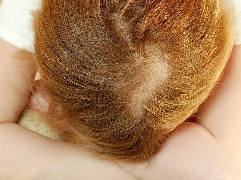 у ребенка сухой волос