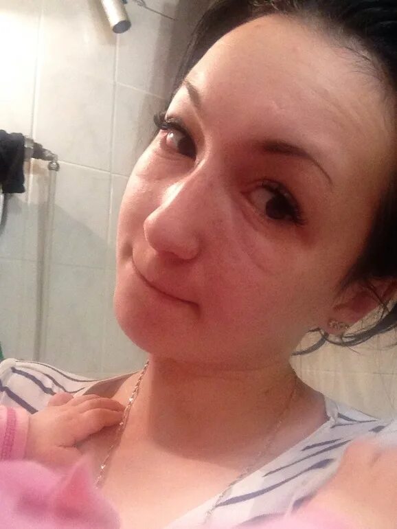 Реакция на нарощенные ресницы. Аллергия на нарощенные ресницы. Некачественное наращивание ресниц. Аллергия от наращивания ресниц. Аллергия на нарощенные ре.