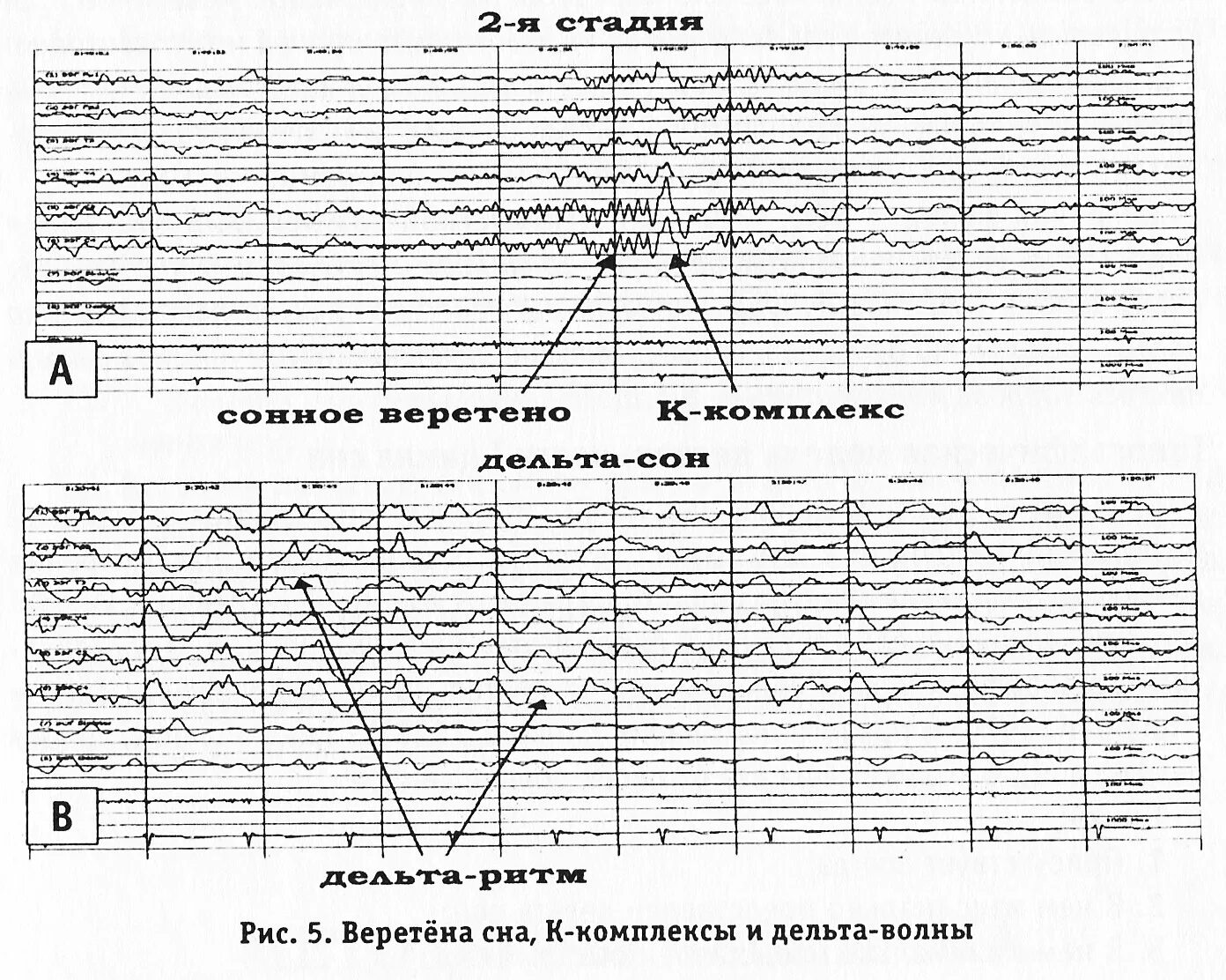 Веретена на ээг. Веретена сна на ээг. Сонные веретена на ээг норма. Веретена сна на ээг. Фазы сна ээг.