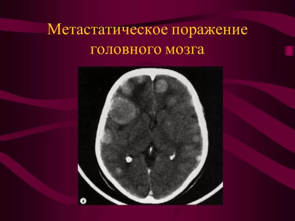 Многоочаговые поражения головного. Метастатическое поражение головного мозга. Метастатические опухоли головного мозга. Вторичные Метастатические опухоли головного мозга. Метастатическое поражение головного мозга классификация.