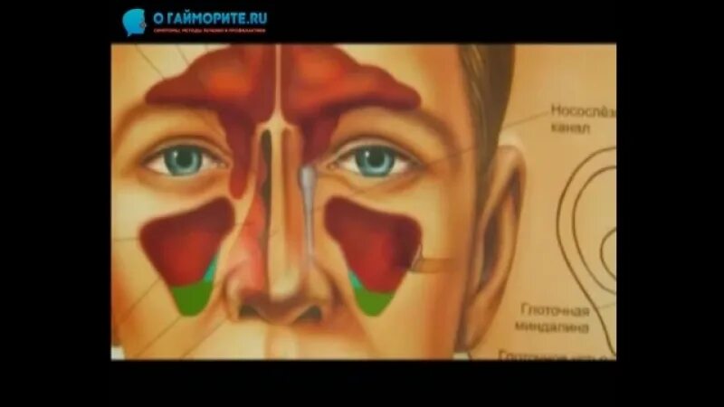 Синусит можно греть нос. Прогревание пазух носа при гайморите. Прогревание солью пазух носа гайморит.