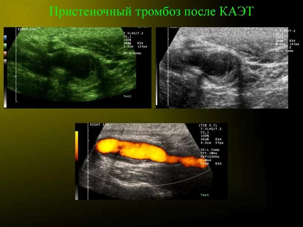 Пристеночный компонент. Пристеночный тромб ПДВ. Киста с пристеночным компонентом. Пристеночный тромбоз нарушения.