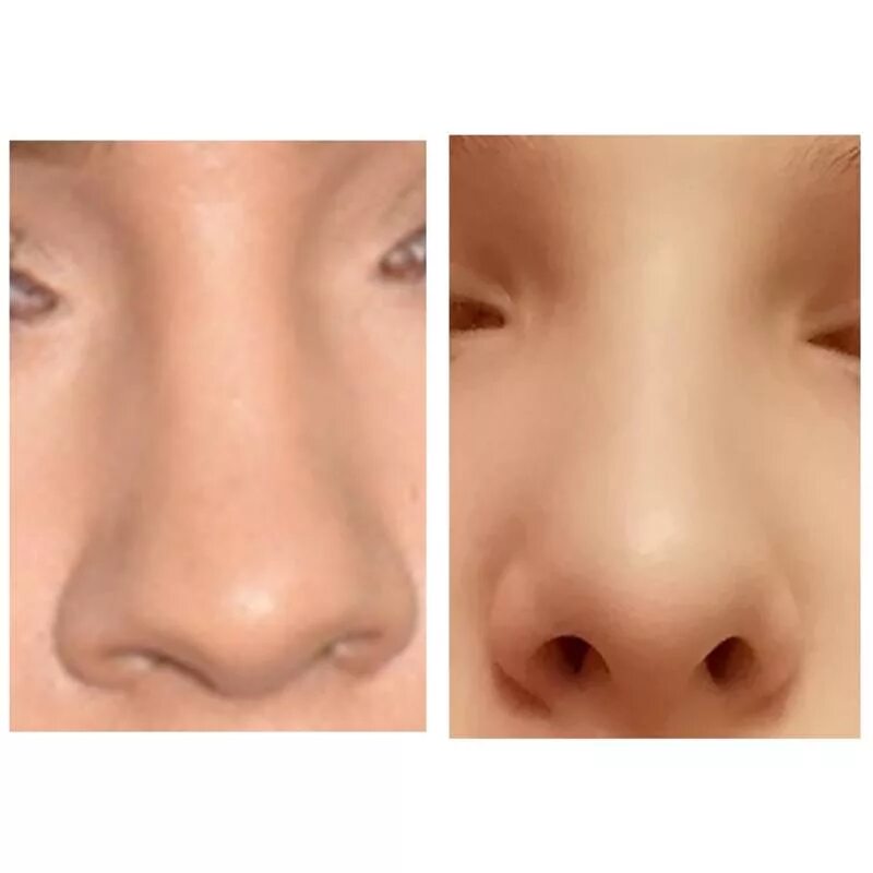 ринопластика носа картошкой. пластика носа. нос картошкой в профиль. ринопластика носа картошкой. ринопластика носа картошкой.