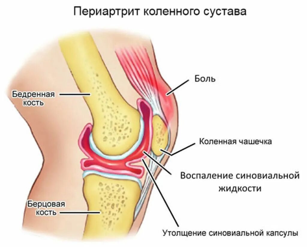 препателлярный бурсит. синовит тазобедренного сустава. суставная синовиальная жидкость колена. жидкость под чашечкой. жидкость в коленном суставе синовит.