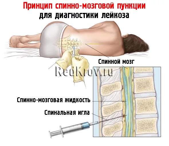 Костный мозг подвздошной кости. Пункция костного мозга памятка. Стернальная пункция острый лейкоз. Стернальная пункция при лейкозе. Пункция костного мозга грудины что.