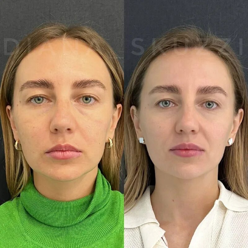 моделирование лица. подтянутое лицо. лицо до и после фейсбилдинга. ботокс для лица. подтянутые скулы.