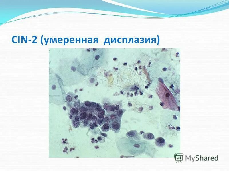 Cin шейки. Дисплазия клеток плоского эпителия. дисплазия шейки матки цитология. дисплазия шейки матки cin 1. плоский эпителий цитология.