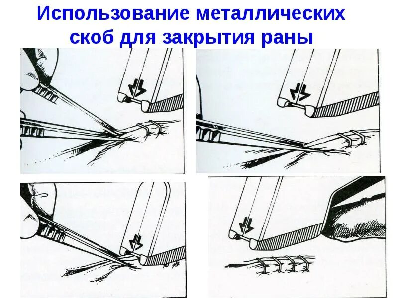 Как вытаскивают скобы