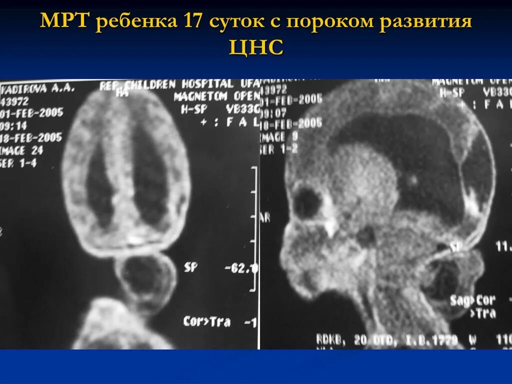 Внутриутробное недоразвитие головного мозга. Врожденные пороки развития центральной нервной системы. Пороки развития формирования ЦНС. Пороки развития головного мозга мрт. Врожденный порок развития центральной нервной системы у детей.