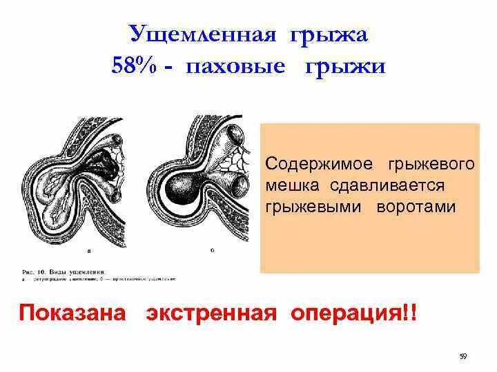 Ущемление пахово мошоночной грыжи. Пахово мошоночная грыжа клинические рекомендации. Не ущемленная паховая грыжа. Клинические признаки ущемленной паховой грыжи.