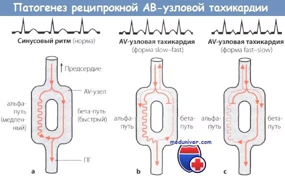 Тахикардия в вертикальном положении. Атриовентрикулярная узловая реципрокная тахикардия (авурт). реципрокная av узловая тахикардия. атриовентрикулярная реципрокная тахикардия на экг. авурт на экг.