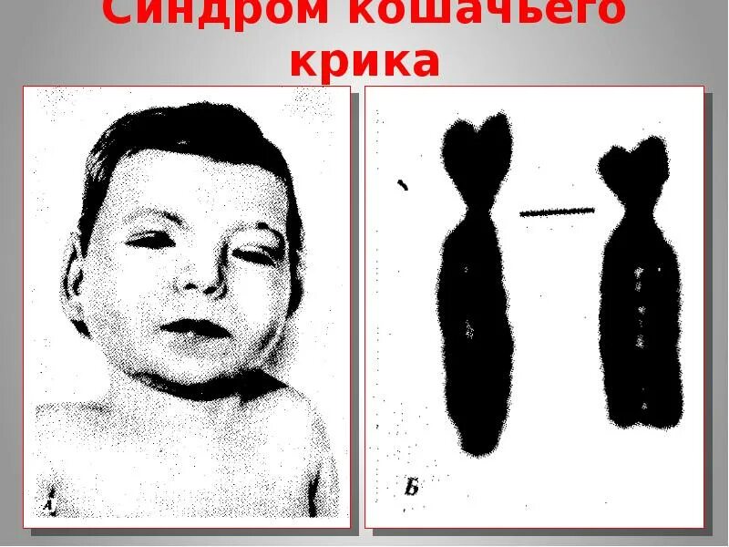 Что такое синдром крика. Синдром «кошачьего крика» (делеция 5р-). синдром «кошачьего крика» (делеция короткого плеча 5-й хромосомы). диагностические признаки синдрома кошачьего крика.