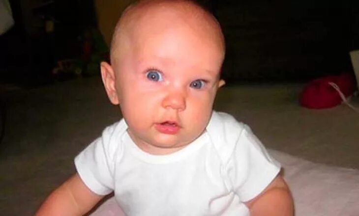 краниостеноз тригоноцефалия. тортиколлис шеи у детей. позиционная асимметричная брахицефалия. асимметрия головы у ребенка. асимметрия глаз у новорожденного.