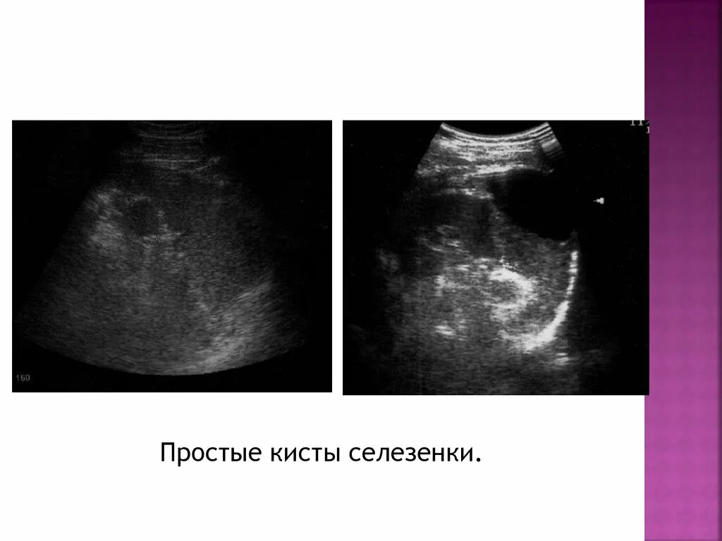 Киста селезенки мкб. Субкапсулярная киста селезенки. УЗИ многокамерная киста селезенки. Селезенка с кистой макропрепарат. Гидатидная кисты селезенки.