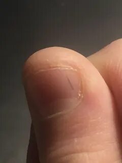 Вертикальные полосы на ногте большого пальца