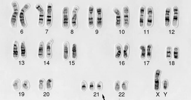 Синдром Дауна 21 хромосома. Синдром Дауна трисомия 21 хромосомы. Кариограмма синдрома Дауна. Наличие лишней хромосомы