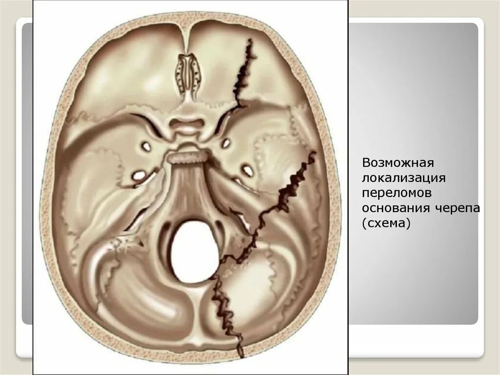 Для перелома основания черепа характерно. Перелом основания черепа. Перелом свода основания черепа. Перелом костей основания черепа. При переломе основания черепа.