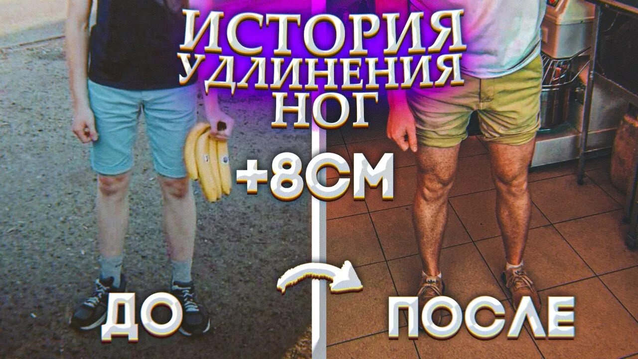 Увеличение роста удлинение ног. Удлинение ног аппаратом Илизарова. Упражнения для удлинения ног.