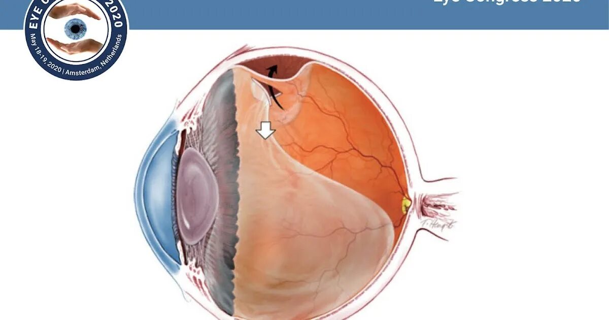 Отслоение сетчатки глаза. Отслойка сетчатки глаза. Отслойка сетчатки отчего. Отслоение сетчатки глаза симптомы.
