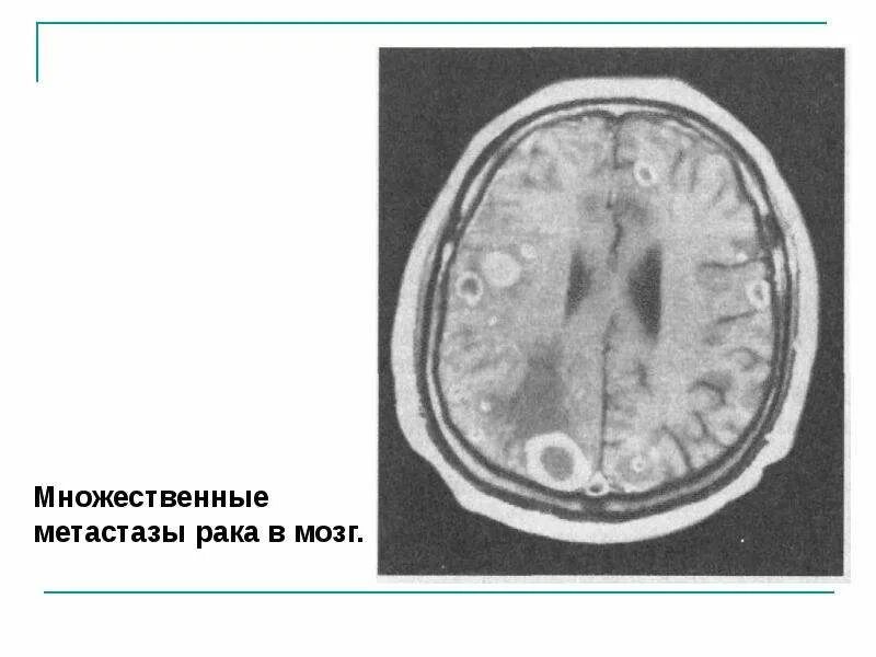 Сколько живут с метастазами в головном мозге. Многочисленные опухоли головного мозга. многочисленные новообразования в головном мозге. множественные метастазы в головной мозг.