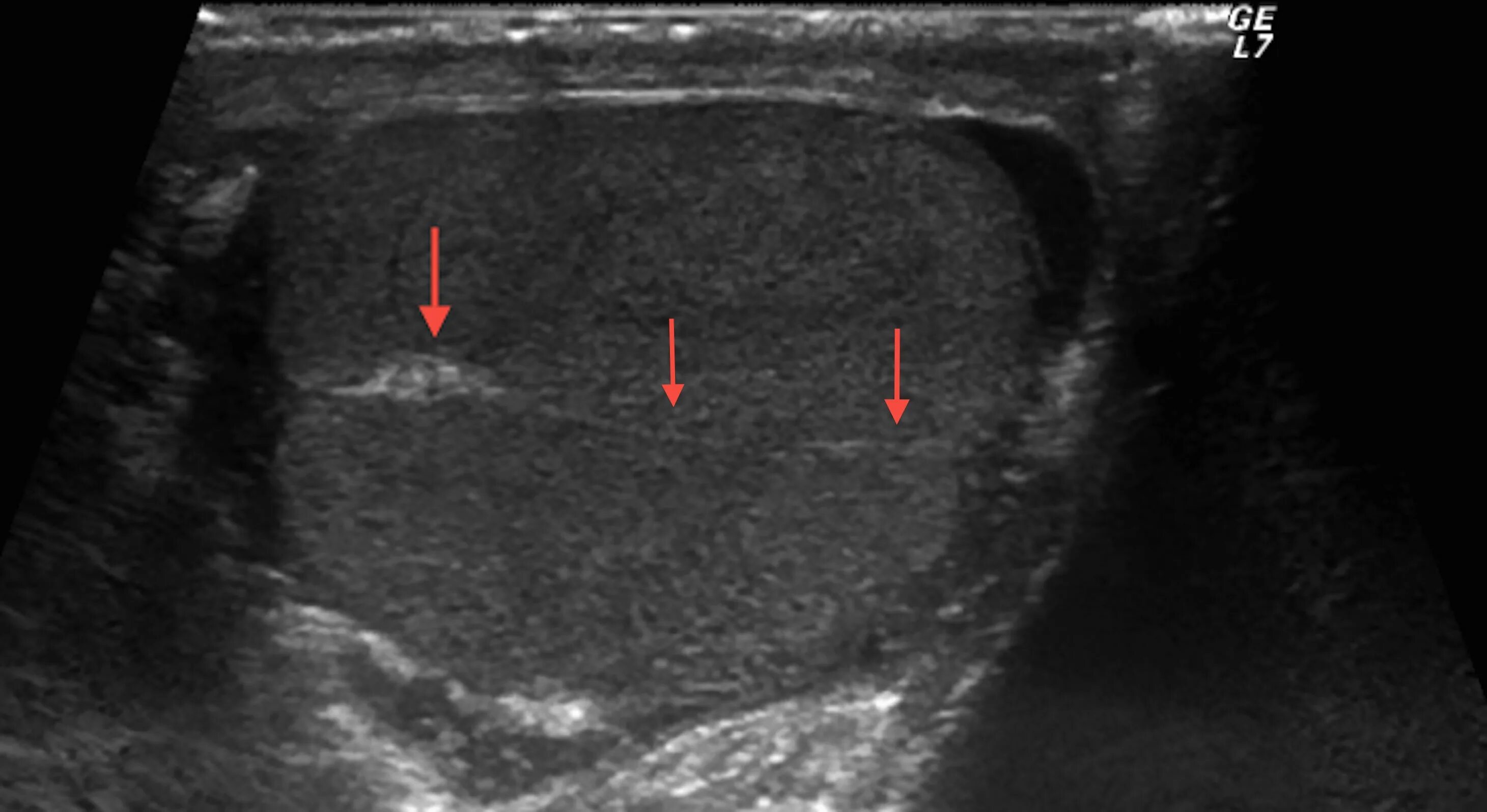 Яички мужчин цена. Ультразвуковое исследование органов мошонки (яички, придатки). УЗИ предстательной железы и мошонки. Киста придатка яичка на УЗИ.