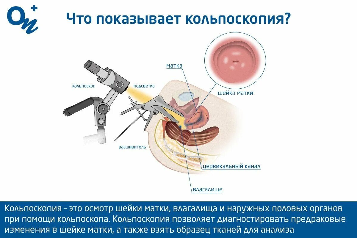 Кольпоскопия как делают. Кольпоскопия как делают