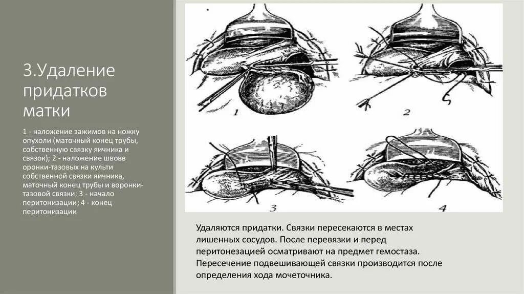 Сколько живут после удаления матки