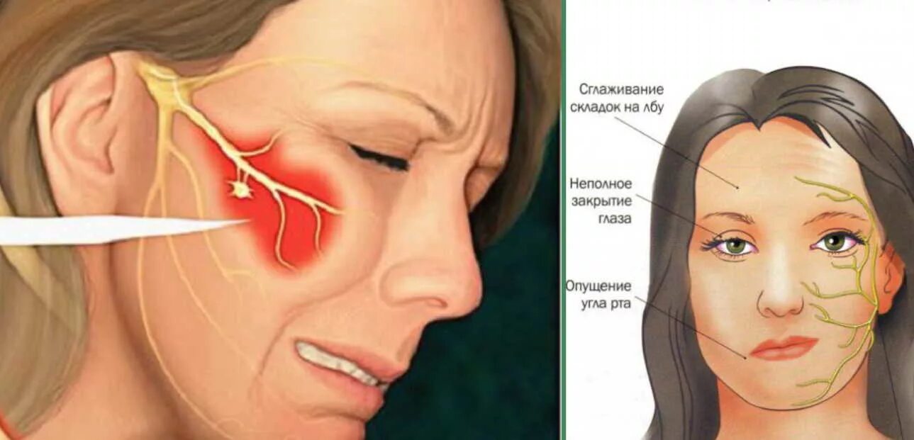 Воспаление тройничного лицевого нерва симптомы. Прозопалгия левосторонняя прозопалгия. Лицевой нерв и тройничный нервы это. Неврит тройничного нерва симптомы.