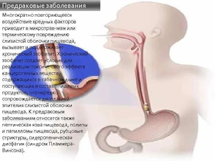 Предраковые заболевания пищевода. Понятие предраковых заболеваний пищевода. Повреждение слизистой оболочки пищевода вызывают. Профилактика предраковых заболеваний пищевода.