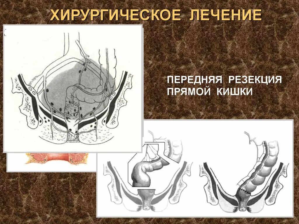 Операции через прямую кишку. Брюшно-промежностная экстирпация прямой кишки. Внутрибрюшная передняя резекция прямой кишки. Передняя резекция прямой кишки схема. Передняя чрезбрюшинная резекция прямой кишки.