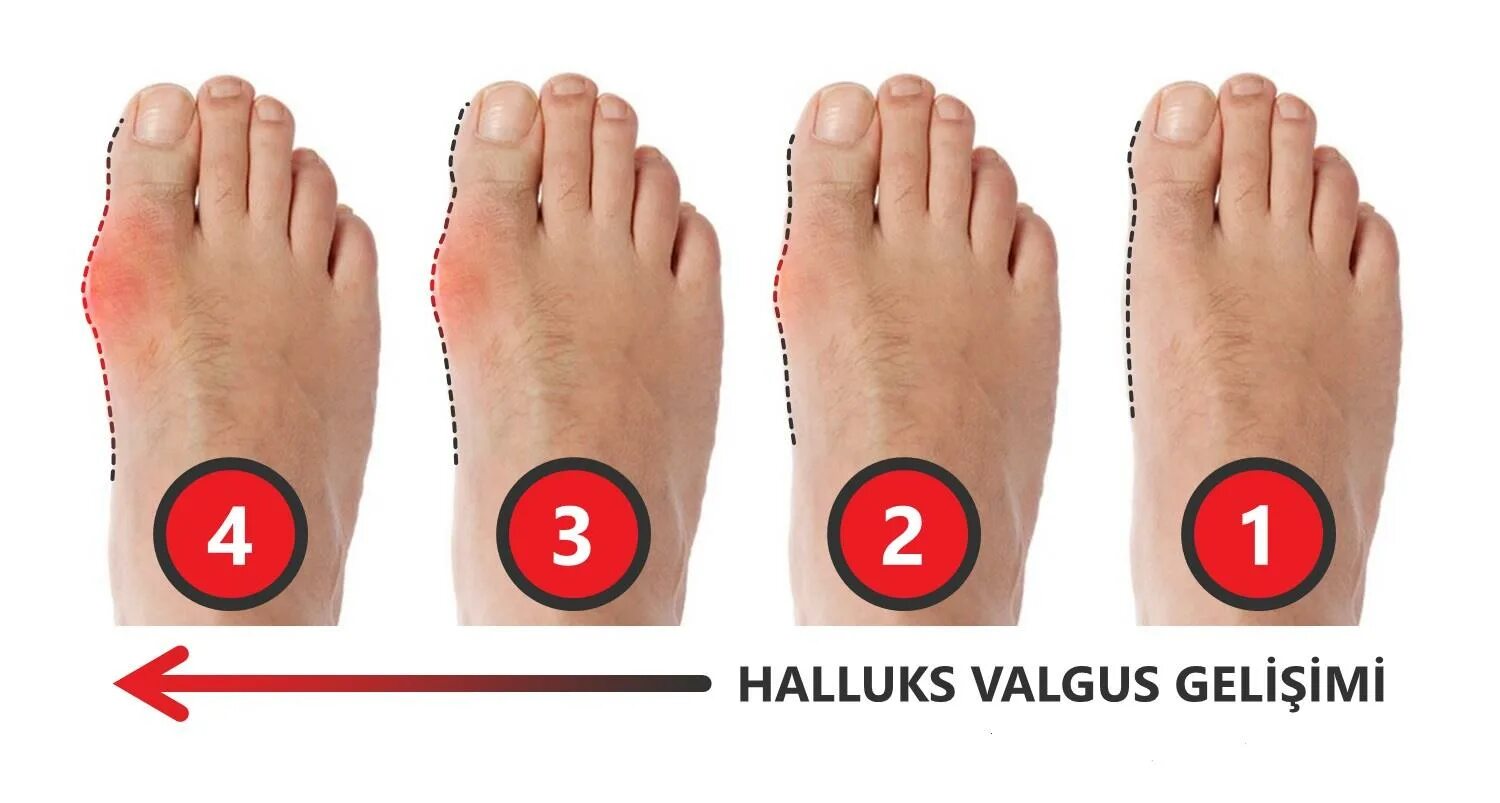 Степени вальгусной деформации 1 пальца. Вальгусная деформация 2 степени. Вальгусная деформация большого пальца стопы. Степени вальгусной деформации. Вальгус деформация большого пальца стопы.