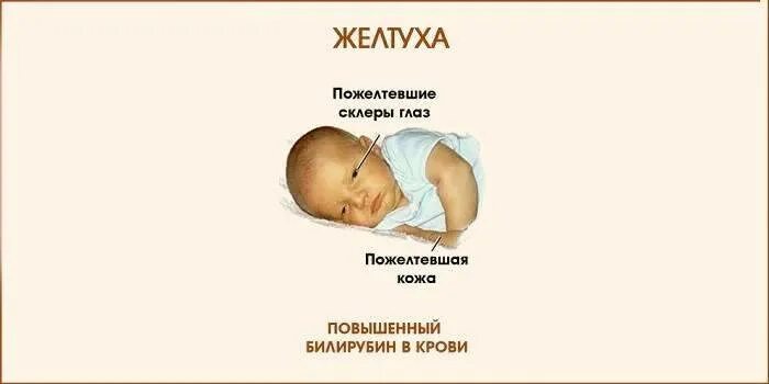 Желтушка у младенца после родов. Цвет кожи при желтухе у новорожденных. Желтушка у младенца после родов. Желтуха у недоношенных детей. Неонатальная желтуха ноаорожд.