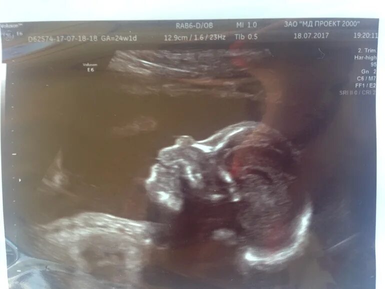 Плодное яйцо и желточный мешочек. Узи 8 недель беременности гипертонус. Узи 8 недель. Узи 1 триместр. 40 3 недели форум.
