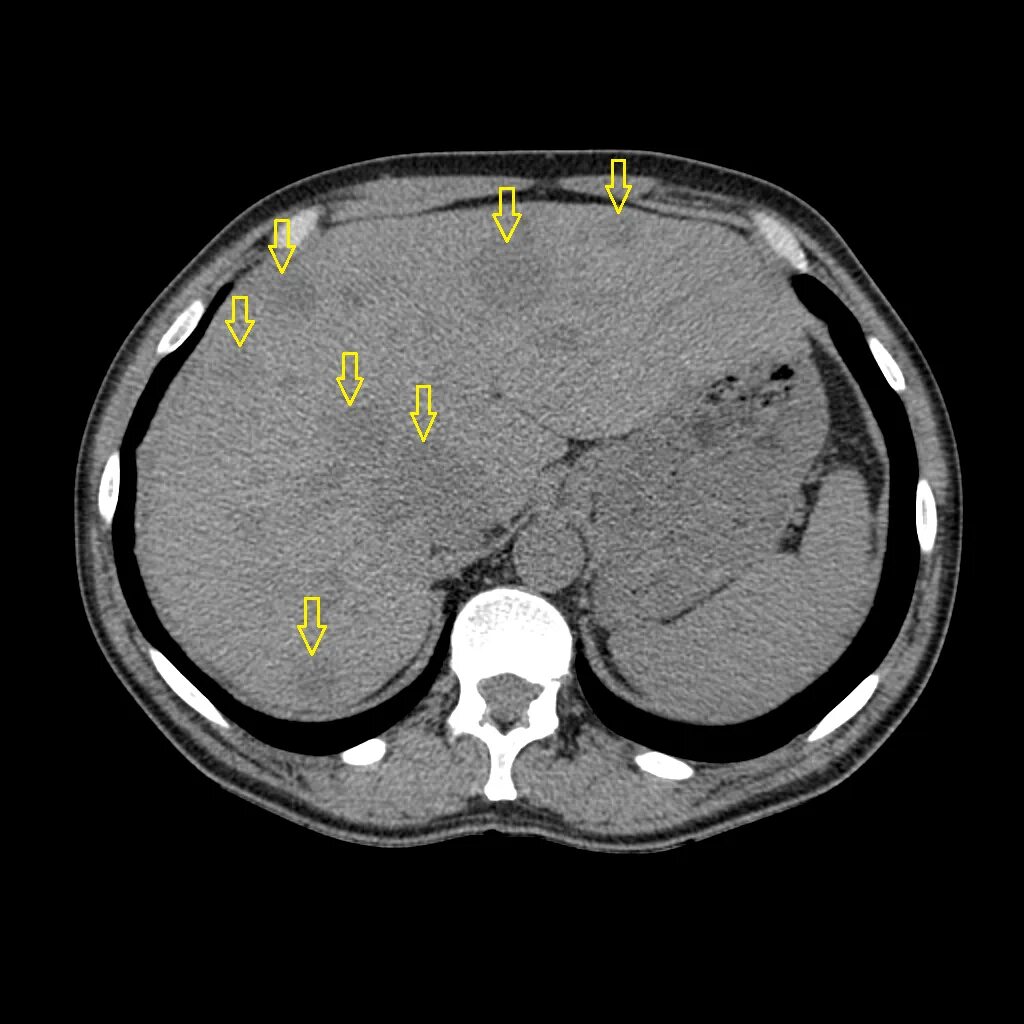 Гиподенсный очаг печени кт. Гиподенсные образования в печени что это такое на кт. Гиподенсивное образование в печени на кт. Образования печени кт