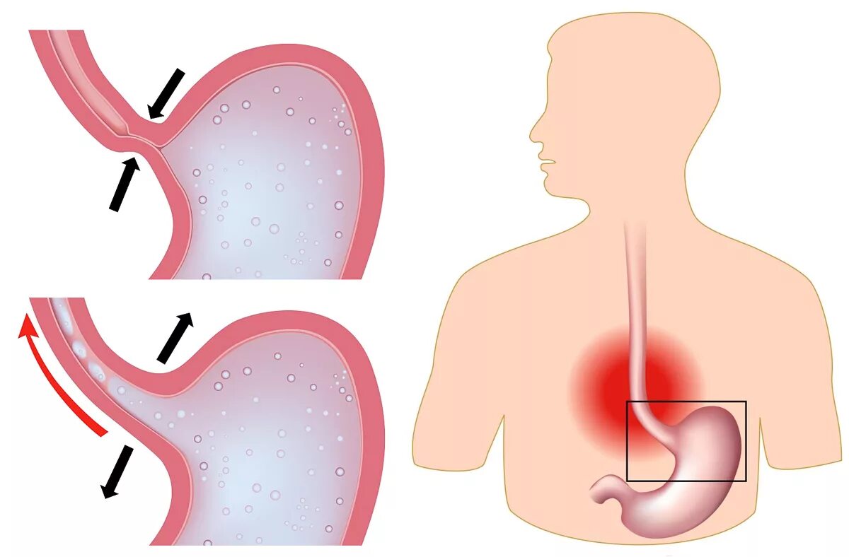 Пищевод открывается в желудок. Гастроэзофагеальная рефлюкс эзофагит. Гастроэзофагеальный рефлюкс болезнь. Рефлюксная болезнь желудка рефлюкс. Гастроэзофагеальный рефлюкс с эзофагитом.