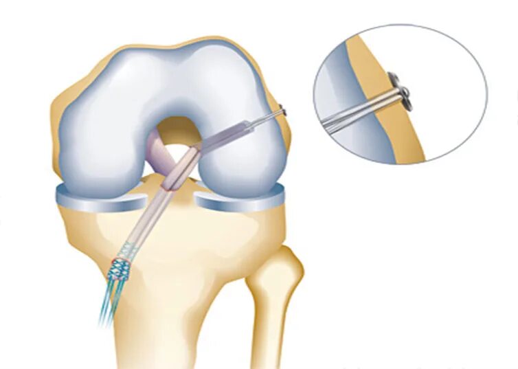 Болит ли мениск. Мениск коленной чашечки что это такое. Мениск коленной чашечки разрыв. Импланты менисков коленного.