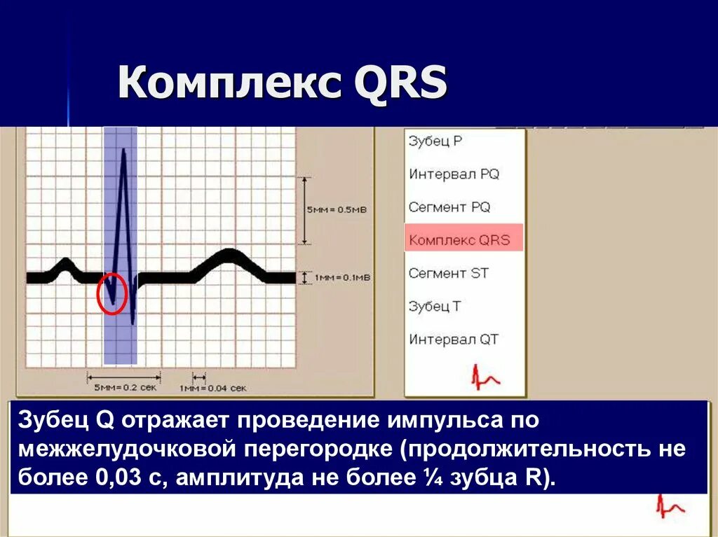 Расширение QRS на ЭКГ. Комплекс QRS. Расширение комплекса QRS. Комплекс QRS расширен.