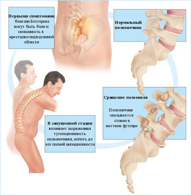 Сильно болит крестец. Анкилозирующий спондилоартрит болезнь Бехтерева. Анкилозирующий спондилит болезнь Бехтерева. Анкилозирующий спондилит симптомы. Болезнь Бехтерева клинические проявления.