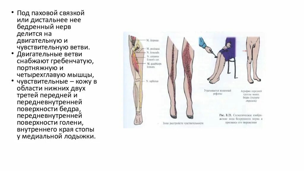 Туннельные невропатии нижних конечностей. Туннельный синдром бедренного нерва. Нейропатия пахово бедренного нерва. Бедренный нерв малоберцовый нерв.