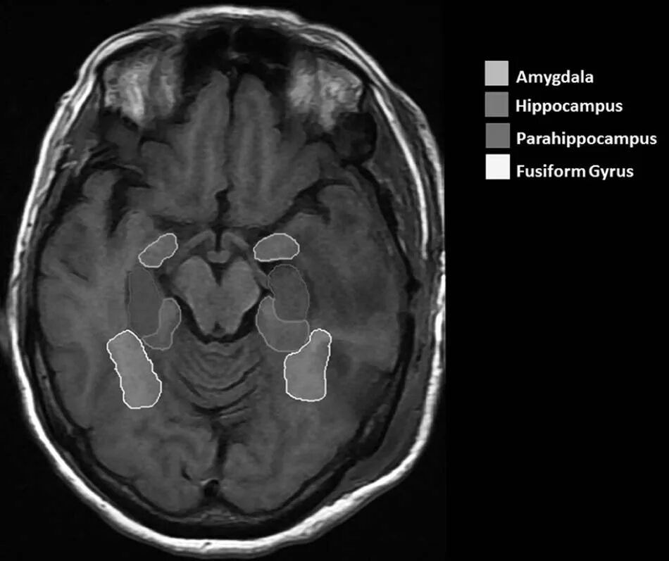 Повреждение гиппокампа. Мрт миндалевидное тело Амигдала. Amigdala гиппокампа. Гиппокамп и миндалевидное тело. Гиппокамп на кт.
