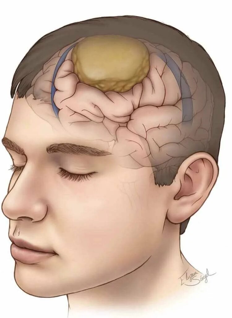 Образование в лобной доле. Злокачественное новообразование головного мозга. Доброкачественная опухоль мозга.