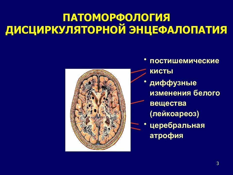 Признаки дисциркуляторных изменений. Инцефалпатия головного могза. Дисциркуляторная энцелофапатия. Дисциркуляторной энцефалопатии.